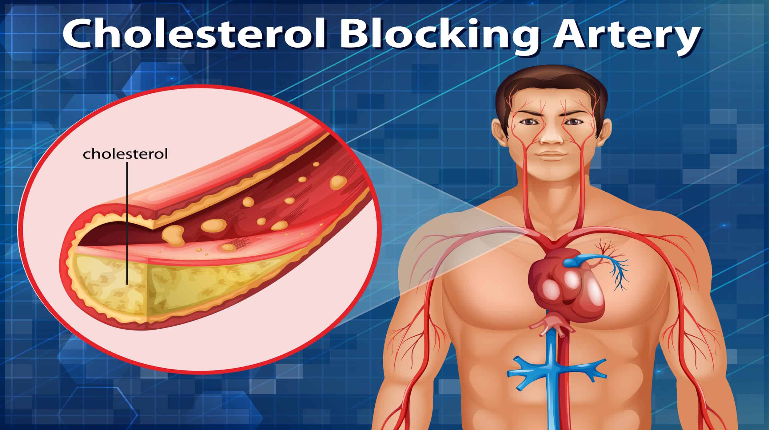 importance of low cholesterol diet