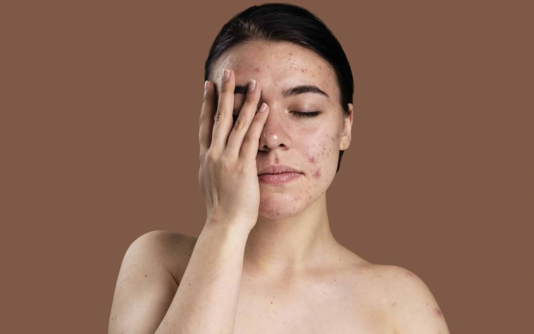Can Dry Skin Cause Acne?